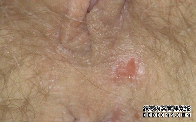 生殖器疱疹的常见症状