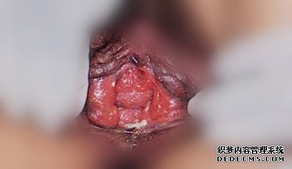 生殖器疱疹一般的症状有哪些