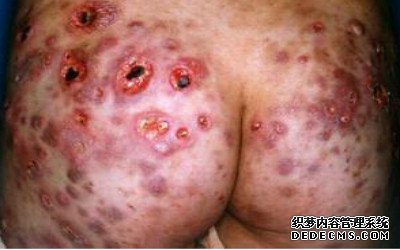 你知道梅毒的症状有哪些吗